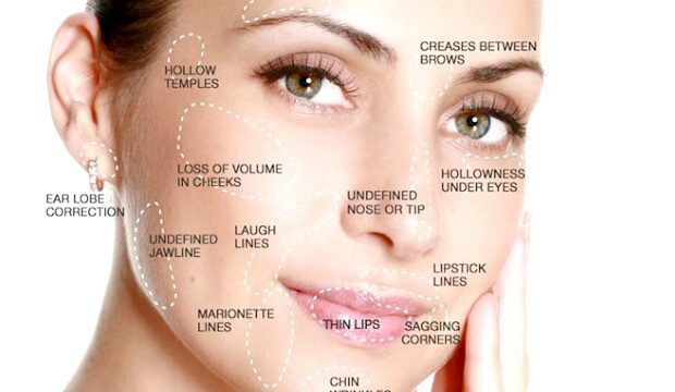 5 Must Know Points On Dermal Fillers