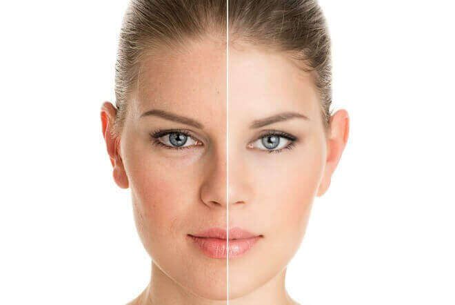 Chemical Peels Vs Microdermabrasion What Is The Difference