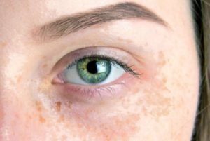 Discolouration Everyday Ways to Lighten Pigmentation