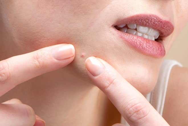 Pimples - How to extract a pimple without damaging the skin?