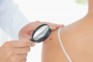 Moles VS melanoma Can you spot the difference