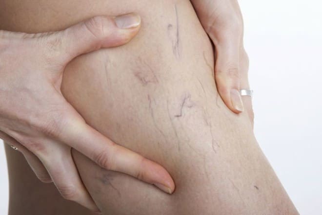 Spider Veins: Say So Long To Those Unsightly Streaks