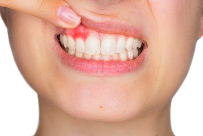 Gingivitis Effective nutraceutical solutions to help beat it
