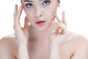 Struggling with spots Salicylic acid is your new BFF