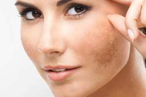 Hormonal pigmentation and how to treat and remove it effectively