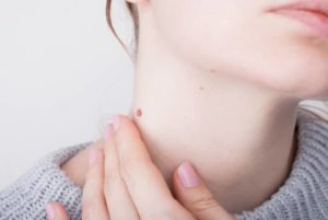 Warts-vs-skin-tags-and-how-you-can-zap-both-in-your-lunch-break