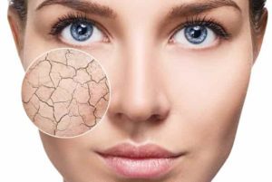 Dehydration Are you mistaking dehydration lines for wrinkles