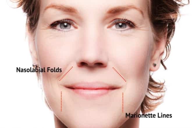 Marionette lines and nasolabial folds - Treat them with injectables!