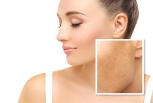 Melasma versus hyperpigmentation and how to treat it