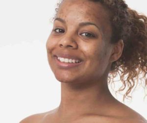 Dark Skin and Pigmentation