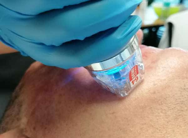 Endymed: Micro-Needling And Radiofrequency To Overhaul Skin