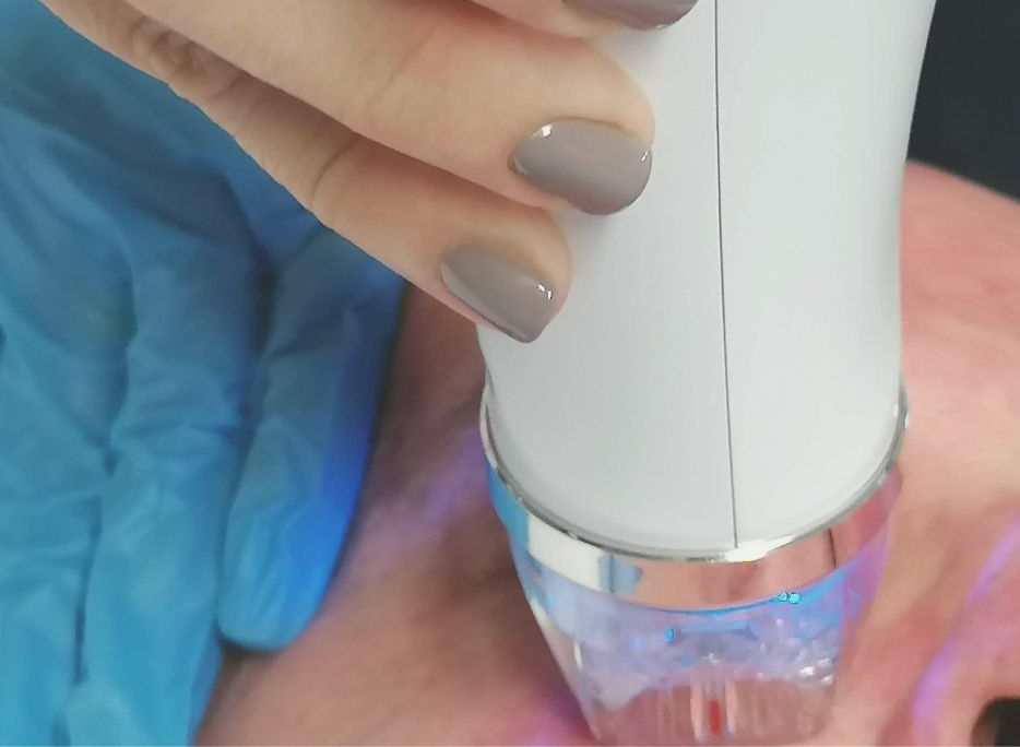 Micro-Needling with Radio Frequency : Why It Can Really Save Skin