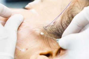 Threads: The Anatomy of Lifting Sagging Skin