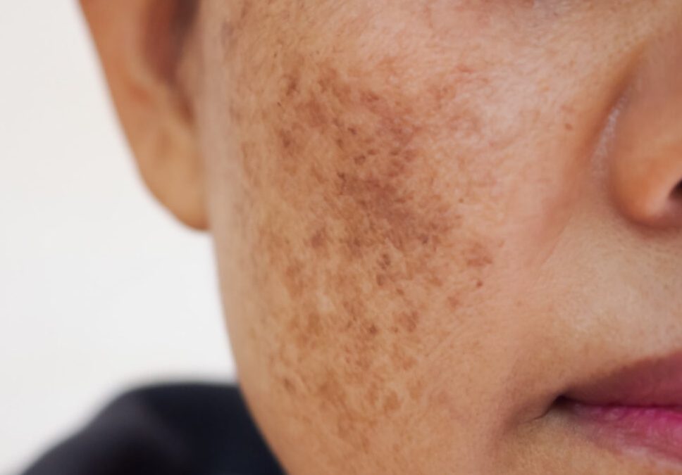 Outsmarting Melasma: Staying Ahead of Dynamic Pigmentation Matters 