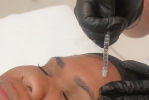 MicroTox: The Magic Combination of Microneedling And Neurotoxins