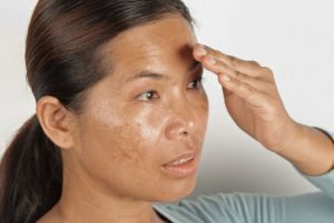 Stubborn Pigmentation: Why Mesobrite is Going To Be The No.1 Solution