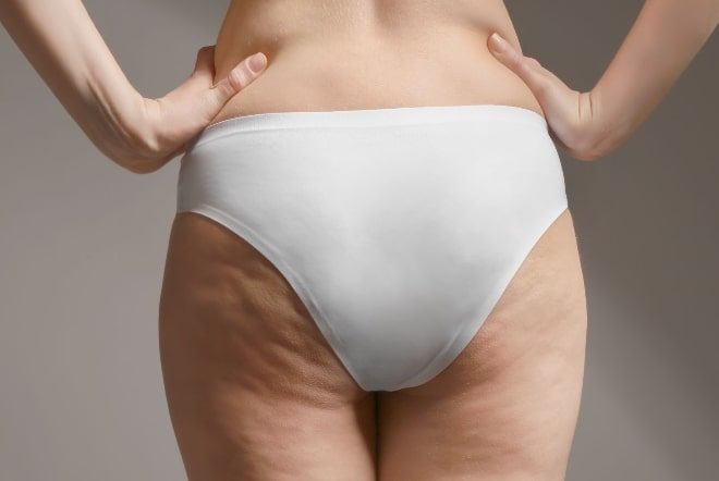 Pico Toning is Redefining Stretch Marks and Scarring